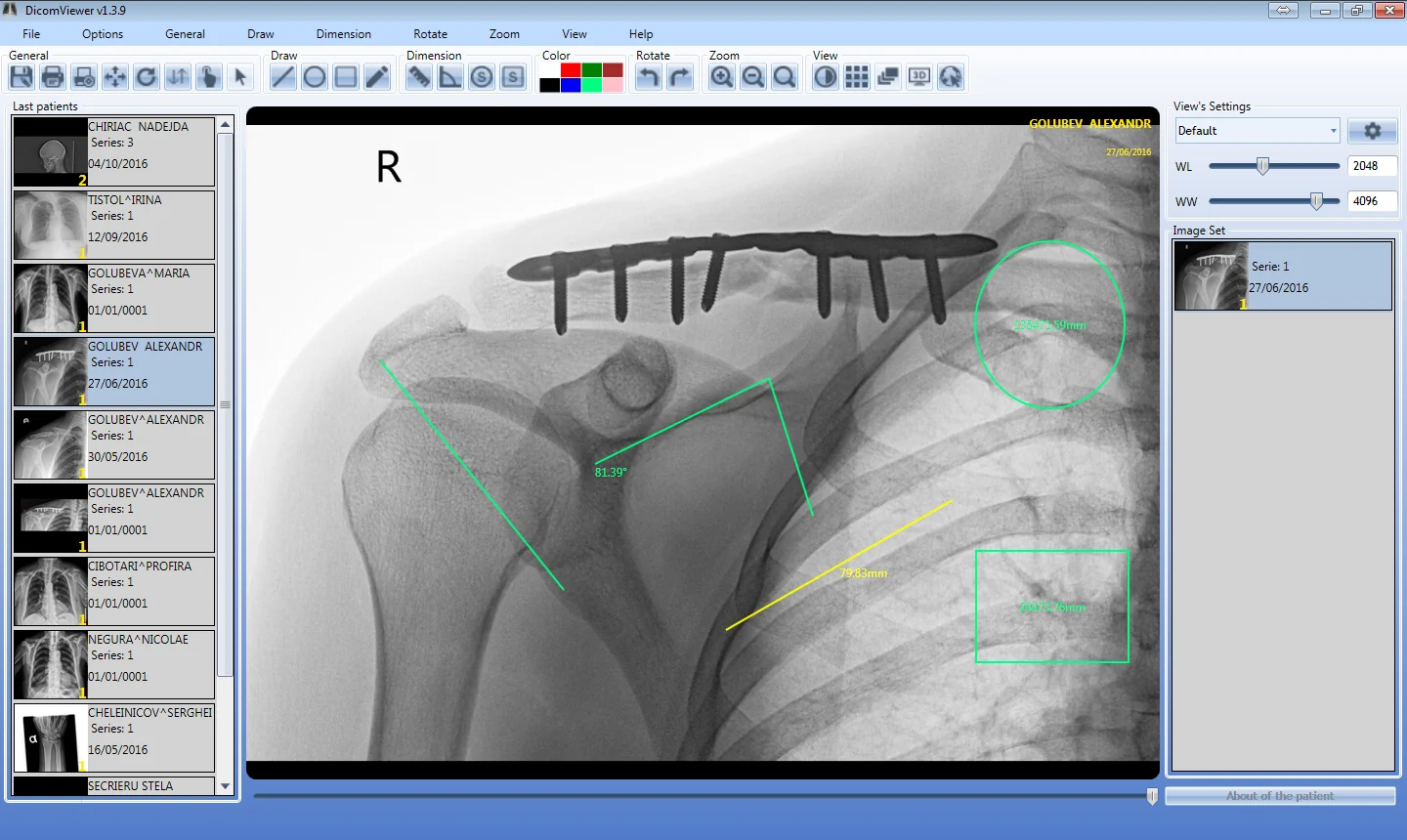 DICOM Viewer: angle, length and area measurements on a shoulder X-ray