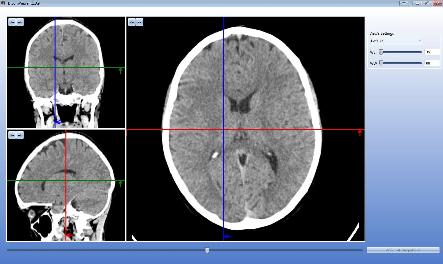 DICOM Viewer: multiplanar reconstruction of a head CT in three planes